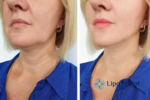 Double chin before and after Hi-Fu treatment 4 Book your double chin treatment Portsmouth today! We are here to help!