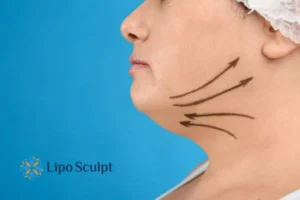 Double chin before and after Hi-Fu treatment 3 Boost your confidence with a Double chin treatment Portsmouth
