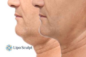 Double chin before and after Hi-Fu treatment 2 Double chin treatment Portsmouth from Lipo Sculpt - feel more confident today!