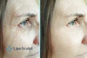 How to Fight Aging Symptoms 2 Do you want to Fight Aging Symptoms Portsmouth? Contact Lipo Sculpt today!