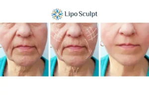 Explaining Morpheus8 And What It Can Do For You 3 Boost your confidence with Morpheus8 Portsmouth call our team today!