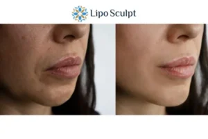 Explaining Morpheus8 And What It Can Do For You 4 Morpheus8 Portsmouth the best results - call our team today!