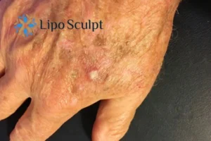 Best Actinic Keratoses Removal 2 Improve your wellbeing and health with Actinic Keratoses Portsmouth removal.treatment
