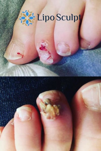 Wart removal customer results from Lipo Sculpt Portsmouth